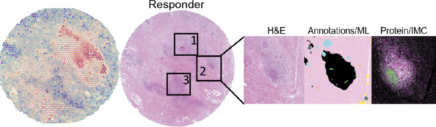 Organized adaptive immune responses following immunotherapy in pancreatic cancer.
